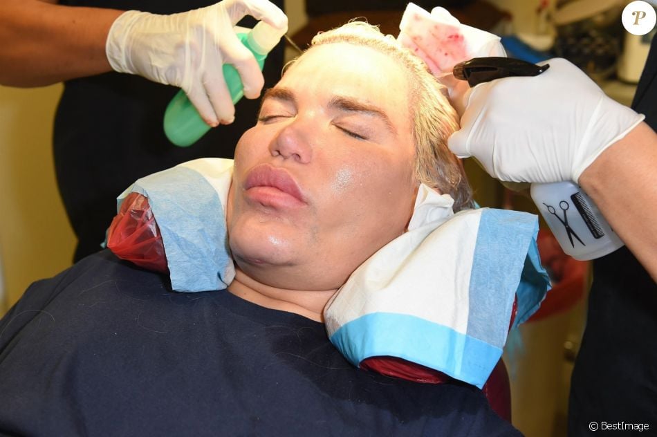 Le Ken humain Rodrigo Alves a fait appel au célèbre Docteur John Kahen pour réaliser une greffe capilaire pour un montant de 25 000 $ à Beverly Hills. Une opération qui a duré 7 heures, le 20 octobre 2017.