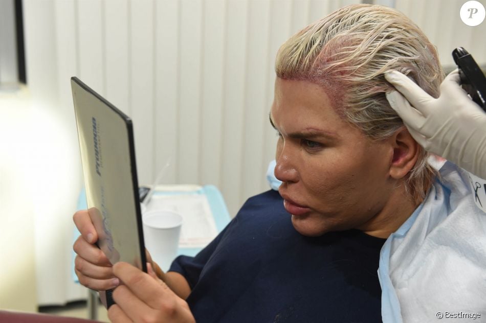 Le Ken humain Rodrigo Alves a fait appel au célèbre Docteur John Kahen pour réaliser une greffe capilaire pour un montant de 25 000 $ à Beverly Hills. Une opération qui a duré 7 heures, le 20 octobre 2017.