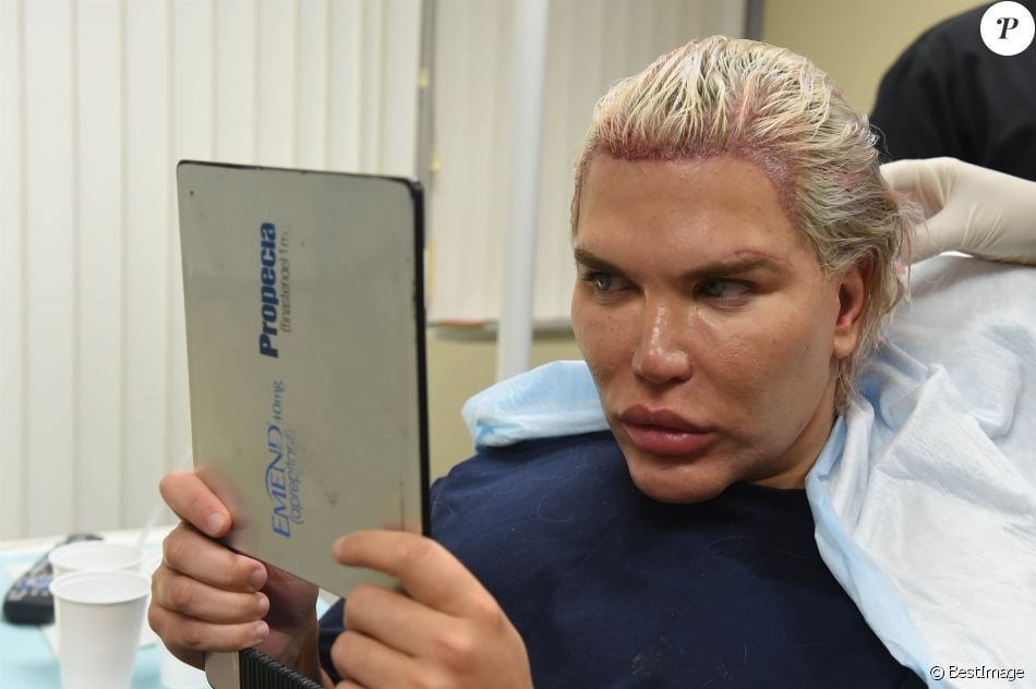 Le Ken humain Rodrigo Alves a fait appel au célèbre Docteur John Kahen pour réaliser une greffe capilaire pour un montant de 25 000 $ à Beverly Hills. Une opération qui a duré 7 heures, le 20 octobre 2017.