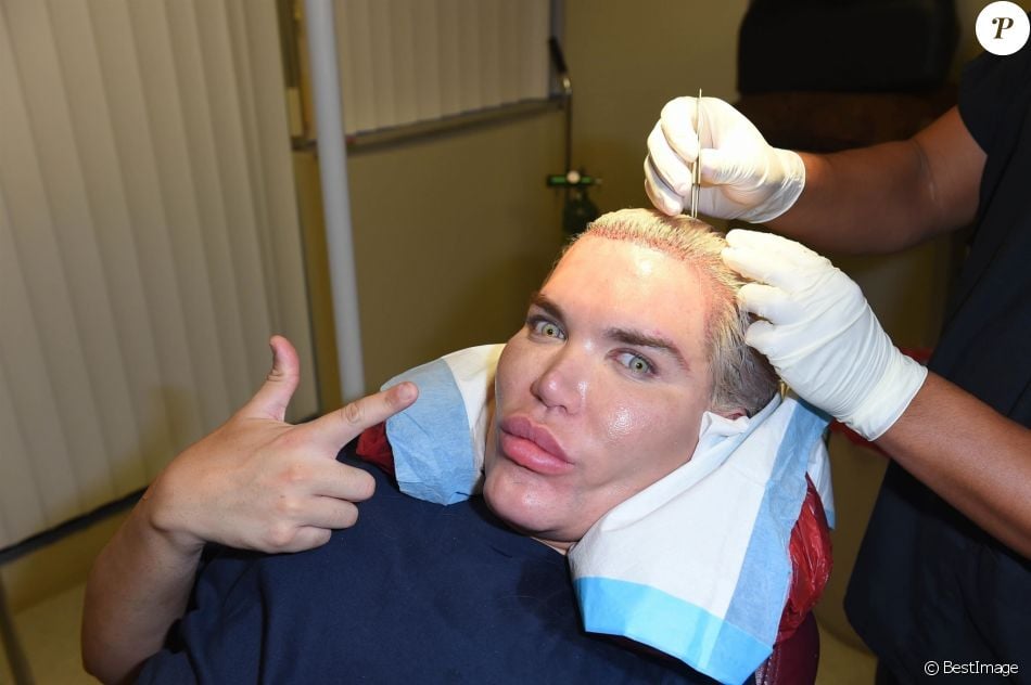 Le Ken humain Rodrigo Alves a fait appel au célèbre Docteur John Kahen pour réaliser une greffe capilaire pour un montant de 25 000 $ à Beverly Hills. Une opération qui a duré 7 heures, le 20 octobre 2017.