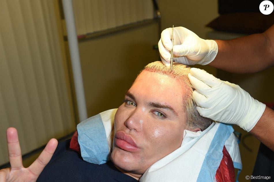 Le Ken humain Rodrigo Alves a fait appel au célèbre Docteur John Kahen pour réaliser une greffe capilaire pour un montant de 25 000 $ à Beverly Hills. Une opération qui a duré 7 heures, le 20 octobre 2017.