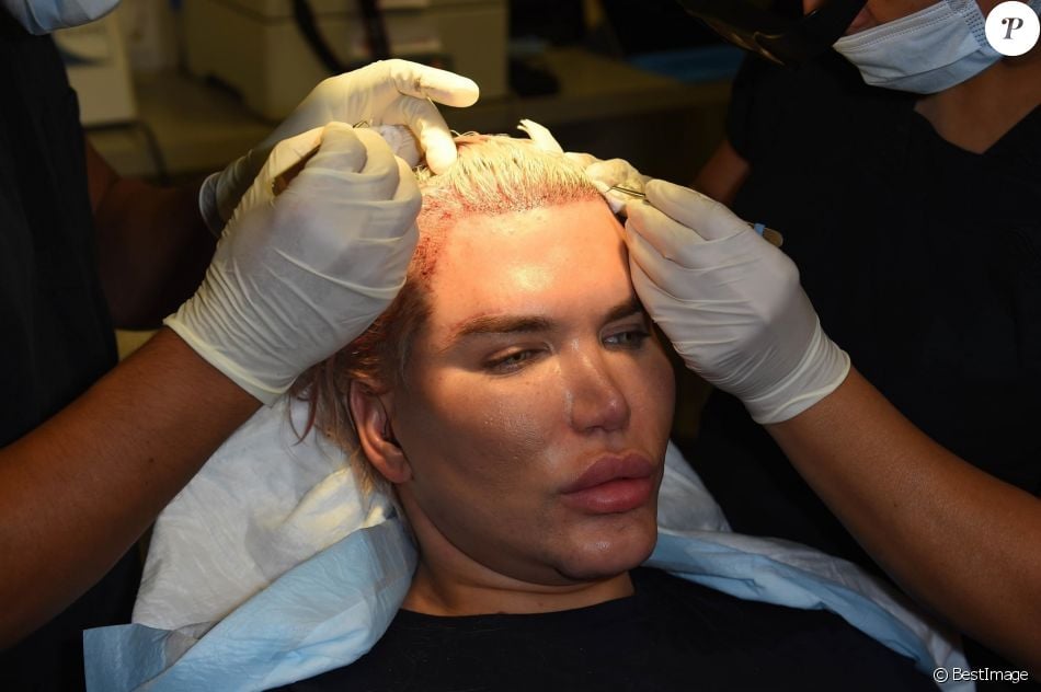 Le Ken humain Rodrigo Alves a fait appel au célèbre Docteur John Kahen pour réaliser une greffe capilaire pour un montant de 25 000 $ à Beverly Hills. Une opération qui a duré 7 heures, le 20 octobre 2017.