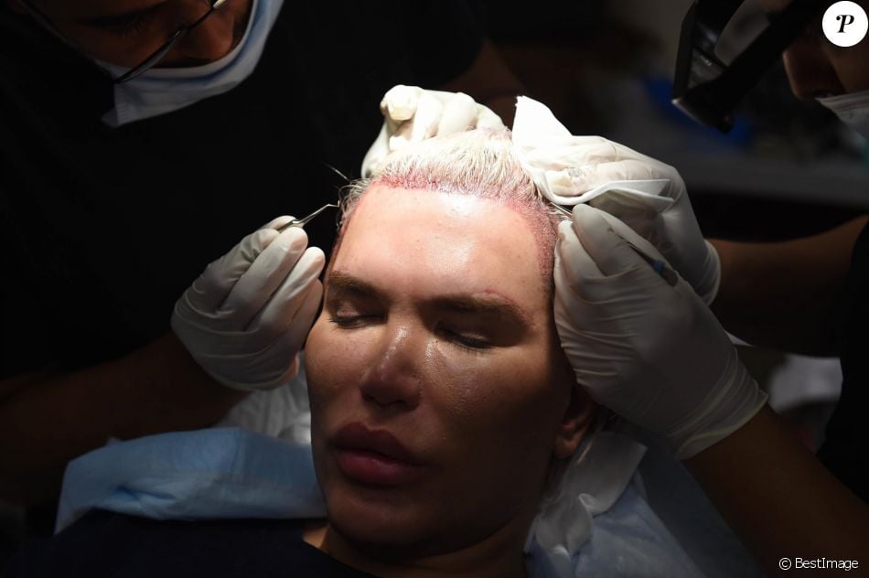 Le Ken humain Rodrigo Alves a fait appel au célèbre Docteur John Kahen pour réaliser une greffe capilaire pour un montant de 25 000 $ à Beverly Hills. Une opération qui a duré 7 heures, le 20 octobre 2017.