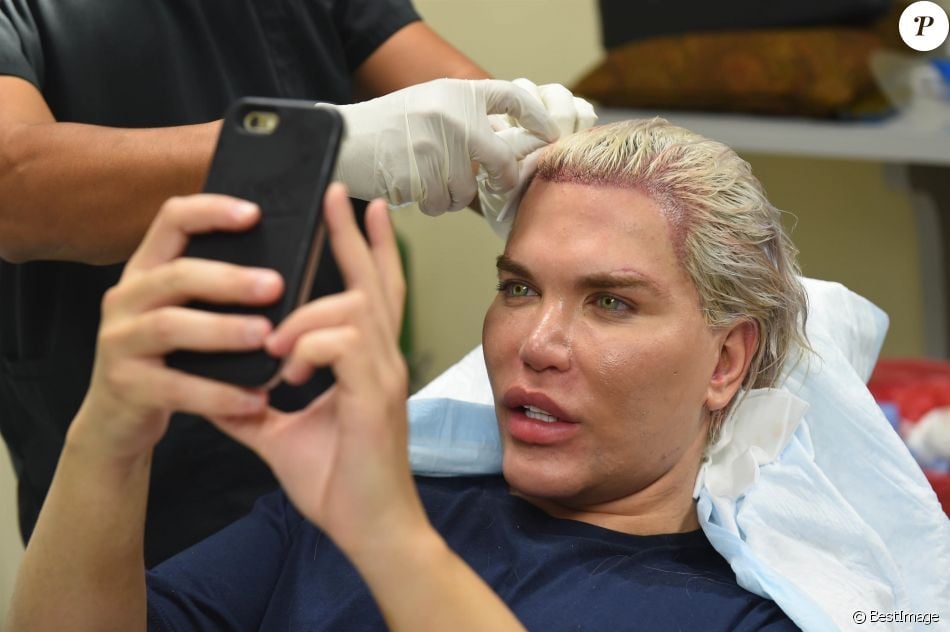 Le Ken humain Rodrigo Alves a fait appel au célèbre Docteur John Kahen pour réaliser une greffe capilaire pour un montant de 25 000 $ à Beverly Hills. Une opération qui a duré 7 heures, le 20 octobre 2017.