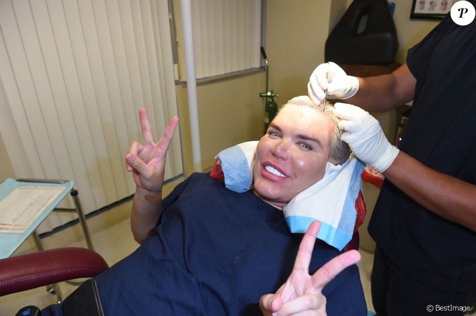 Le Ken humain Rodrigo Alves a fait appel au célèbre Docteur John Kahen pour réaliser une greffe capilaire pour un montant de 25 000 $ à Beverly Hills. Une opération qui a duré 7 heures, le 20 octobre 2017.