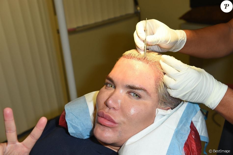 Le Ken humain Rodrigo Alves a fait appel au célèbre Docteur John Kahen pour réaliser une greffe capilaire pour un montant de 25 000 $ à Beverly Hills. Une opération qui a duré 7 heures, le 20 octobre 2017.