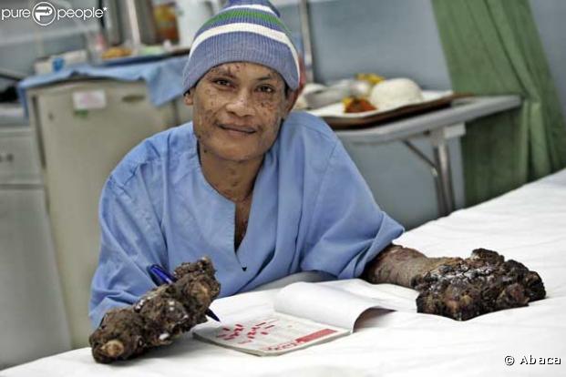 Dede Koswara, l'homme arbre... A l'hôpital, après son opération.