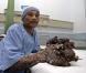 Dede Koswara, l'homme arbre... A l'hôpital, après son opération.
