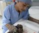 Dede Koswara, l'homme arbre... A l'hôpital, après son opération.