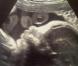 L'échographie du petit Ulises, le bébé de Shakira et Gerard Piqué que ce dernier a postée sur Twitter, le 6 décembre 2012.