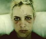 Samantha Ronson bien amochée après son accident de vélo ! Avril 2011