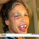 Steven Tyler : Très amoché après une chute, il est méconnaissable