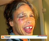 Le visage de Steven Tyler après sa chute le 25 octobre 2011 dans la salle de bain de sa chambre d'hôtel, au Paraguay.
