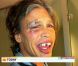 Steven Tyler : Très amoché après une chute, il est méconnaissable