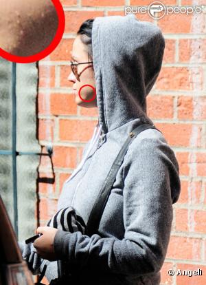 Katy Perry sort d'un rendez-vous chez le médecin, mercredi 4 août à Los Angeles, et apparaît avec de nombreux boutons sur le visage.