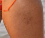 Rihanna affiche quelques bleus sur sa cuisse à la Barbade le 29 décembre 2011
