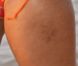 Rihanna affiche quelques bleus sur sa cuisse à la Barbade le 29 décembre 2011