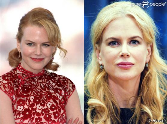 Nicole Kidman a-t-elle fait gonfler ses lèvres ?