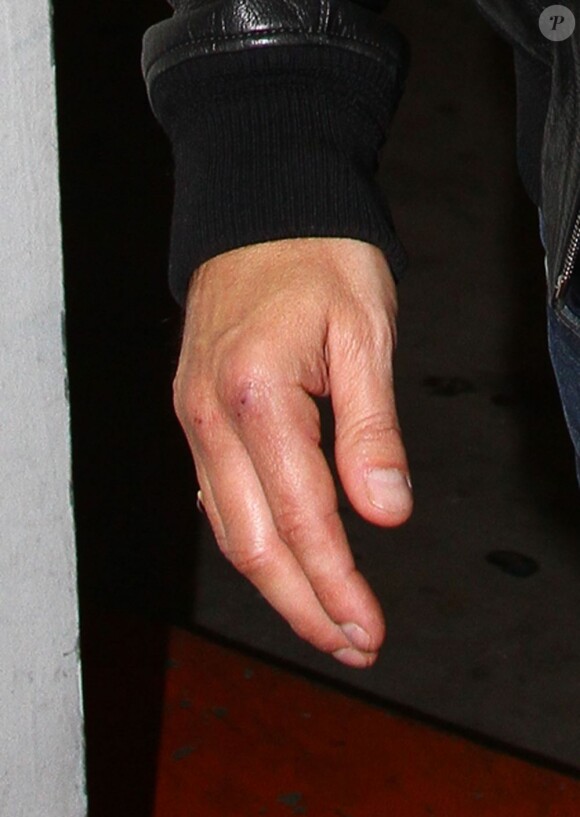 Olivier Martinez se rend chez le médecin à Beverly Hills. On peut encore voir des blessures sur sa main droite suite a sa bagarre avec Gabriel Aubry. Photo prise le 26 novembre 2012.