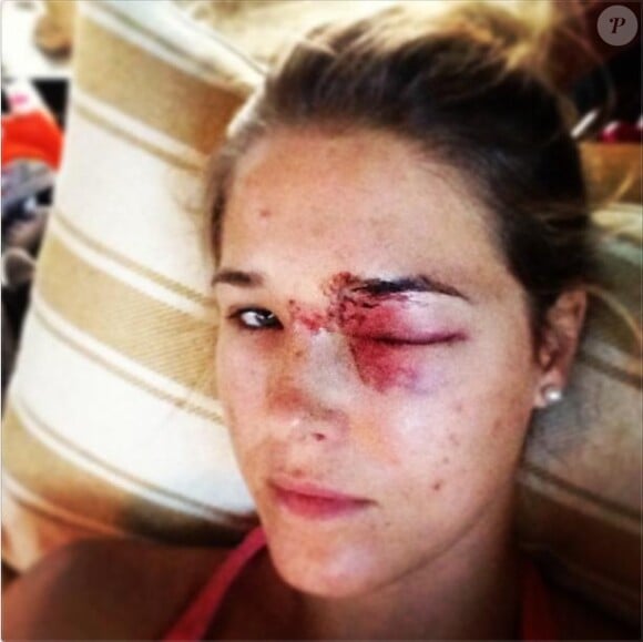 Morgan Beck, après avoir reçu une balle de golf de son homme Bode Miller dans l'oeil, le 12 décembre 2012