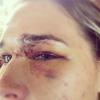 Morgan Beck et son oeil, après avoir reçu une balle de golf de son homme Bode Miller le 12 décembre 2012