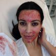  Kim Kardashian subit un lifting facial de vampire. Mars 2013. 