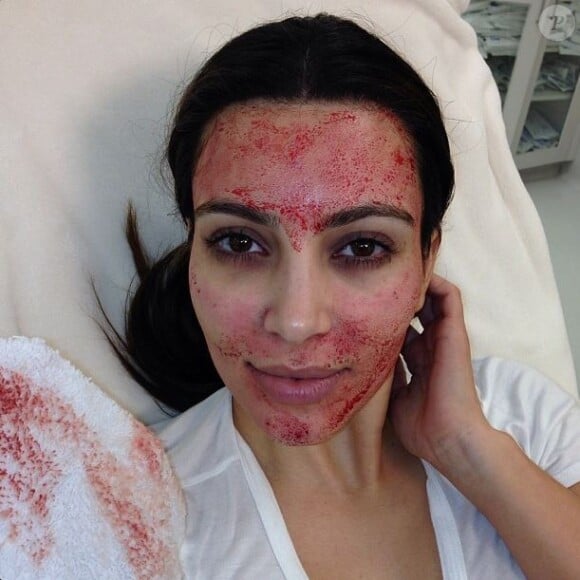 Kim Kardashian subit un lifting facial de vampire. Mars 2013.