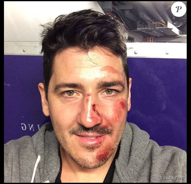 Jonathan Knight New Kids On The Block Le Visage Tumefie Et Le Nez Casse Purepeople