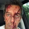 Michel Cymès apparait le visage en sang sur Twitter, le 25 juin 2015.