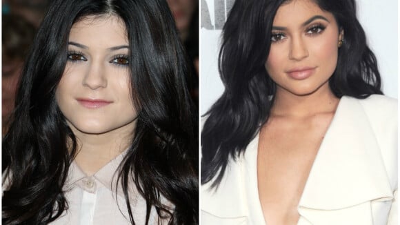 Kylie Jenner métamorphosée par la chirurgie : Son docteur balance !