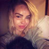 Katie Piper : Le mannequin, agressée à l'acide, révoltée par Halloween