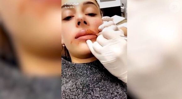 Coralie Porrovecchio en séance de micro-pigmentation des lèvres, Snapchat, décembre 2016