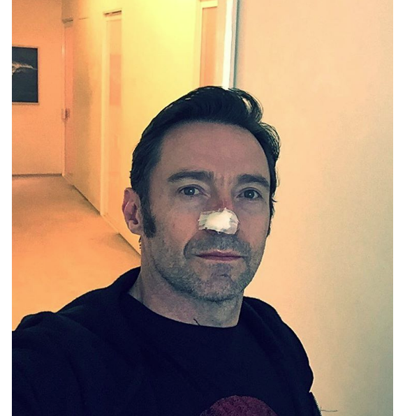 Hugh Jackman après une nouvelle opération visant à retirer un carcinome basocellulaire - Photo publiée le 13 février 2017