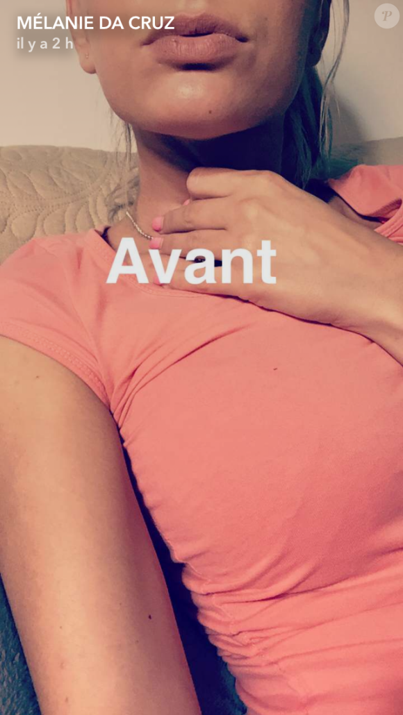 Mélanie Da Cruz s'est offert de nouvelles lèvres pulpeuses et redessinées.