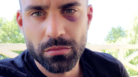 Vincent Queijo blessé après une agression : Il raconte !