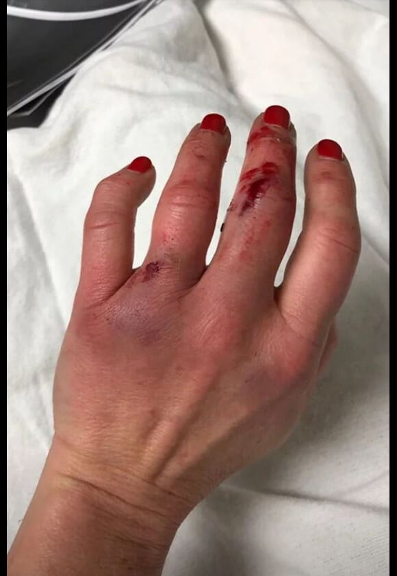 Candace Cameron Bure dévoile ses blessures sur Instagram après son accident de karting survenu le 6 décembre 2018.