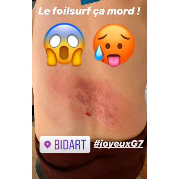 Vincent Cassel blessé sur Instagram, le 24 août 2019.