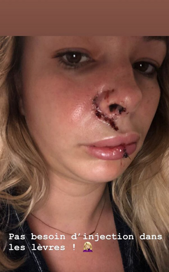 Cindy, candidate de "Koh-Lanta", révèle ses blessures au visage suite à la morsire d'un chien. Octobre 2019.