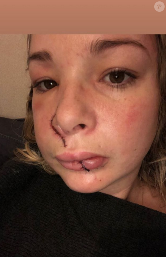 Cindy, candidate de "Koh-Lanta", révèle ses blessures au visage suite à la morsire d'un chien. Octobre 2019.