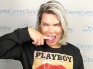 Rodrigo Alves : Le Ken Humain s'est fait injecter ses faux abdos dans les fesses