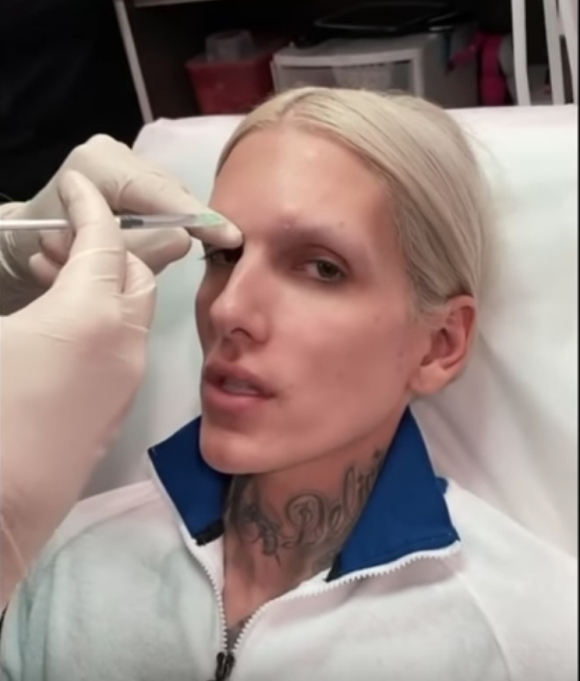 Jeffree Star révèle avoir eu recours à des injections de Botox pour la première fois, le 20 mars 2020.