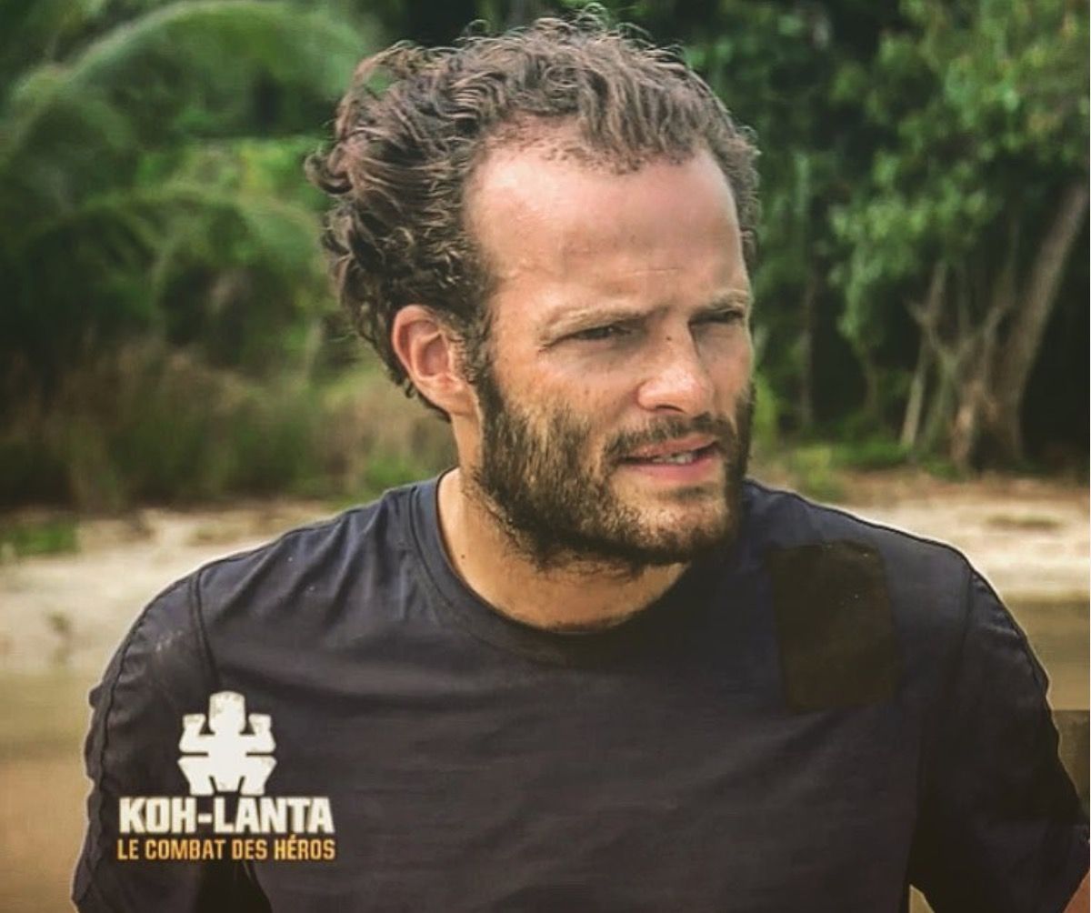 Alban Koh Lanta Defigure Son Visage Tumefie Apres Une Greffe De Cheveux Purepeople