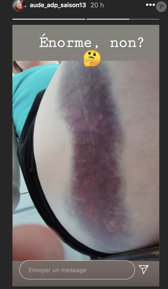 Aude (L'amour est dans le pré) dévoile son énorme hématome en photo - Instagram, 29 mai 2020