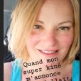 Aude (L'amour est dans le pré) dévoile son énorme hématome en photo - Instagram, 29 mai 2020