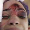 Une jeune lycéenne a été gravement blessée au visage par un tir de flash-ball des forces de l'ordre lors d'une manifestation contre le racisme et les violences policières à Minneapolis. Juin 2020.