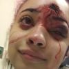 Une jeune lycéenne a été gravement blessée au visage par un tir de flash-ball des forces de l'ordre lors d'une manifestation contre le racisme et les violences policières à Minneapolis. Juin 2020.
