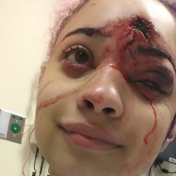 Une jeune lycéenne a été gravement blessée au visage par un tir de flash-ball des forces de l'ordre lors d'une manifestation contre le racisme et les violences policières à Minneapolis. Juin 2020.
