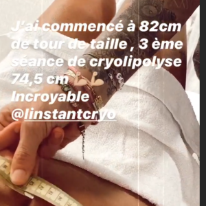 Anaïs Camizuli dévoile le résultat de sa dernière séance de cryolipolyse au ventre - Instagram, 20 juillet 2020