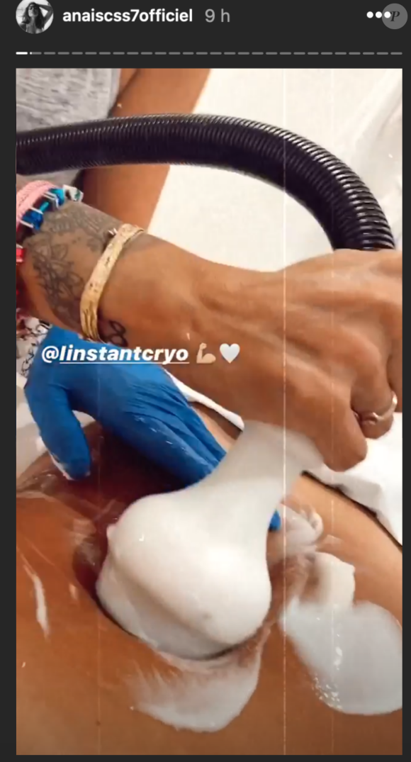 Anaïs Camizuli dévoile le résultat de sa dernière séance de cryolipolyse au ventre - Instagram, 20 juillet 2020