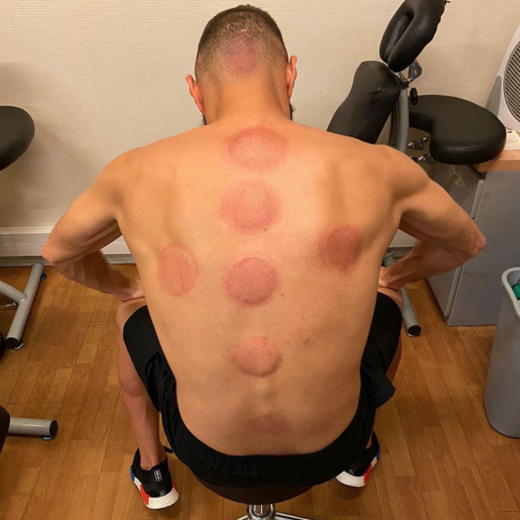 Karim Benzema est un adepte du cupping.